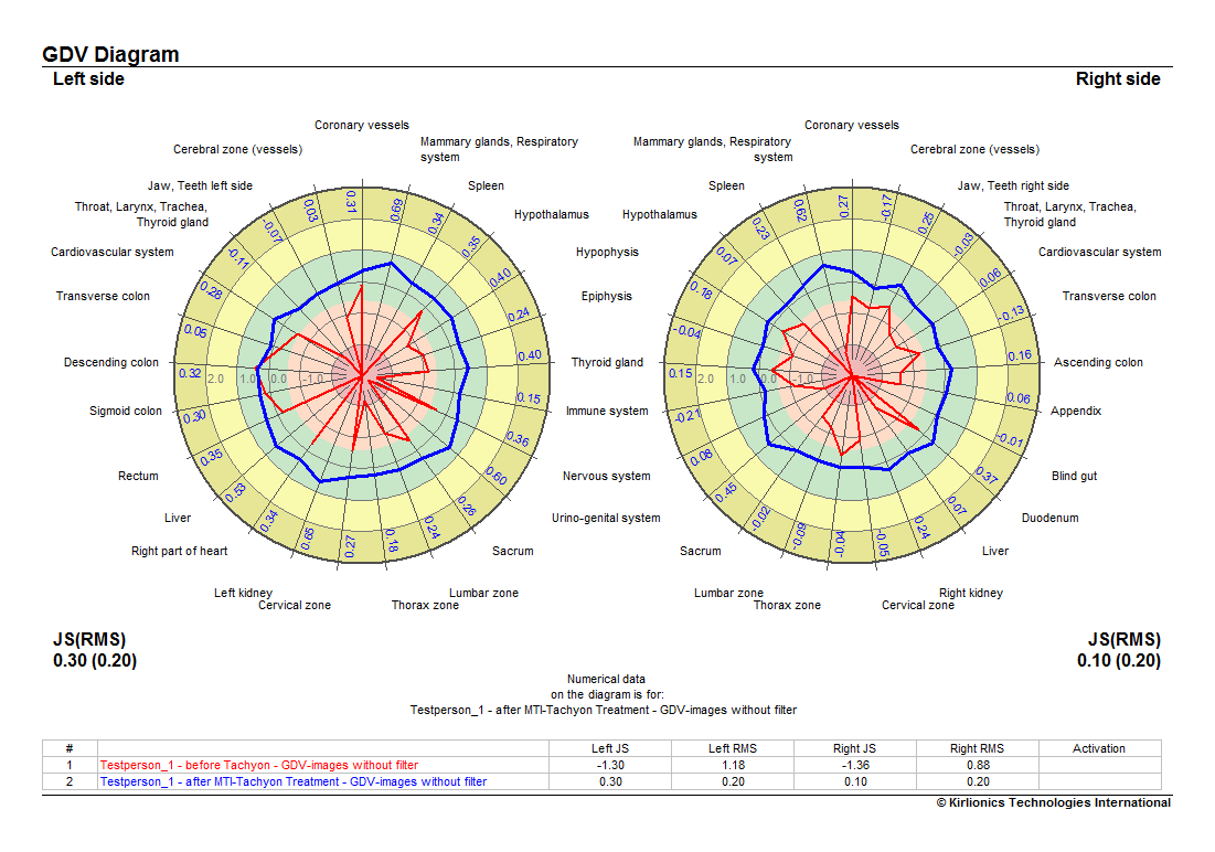 Diagrama GDV radial antes (rojo) y después (azul) del tratamiento MTI-Tachyon